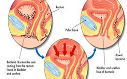 Tại sao phụ nữ dễ bị mắc viêm đường tiết niệu?