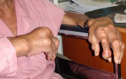 Lắng đọng tinh thể urat ở bệnh nhân gút 