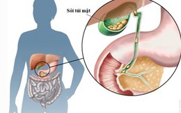 Giữ chi viên sỏi trong túi mật?