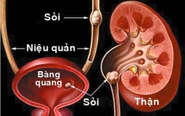 Những điều bạn cần biết về bệnh sỏi thận