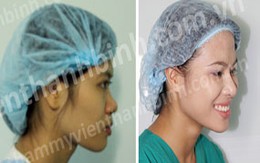 Chọn chất liệu nâng mũi nào để "siêu" bền?