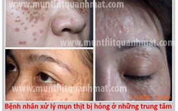 Kinh nghiệm điều trị mụn thịt quanh mắt