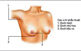Chuyên gia nói về nâng ngực an toàn 