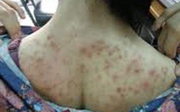 Viêm da vì làm trắng