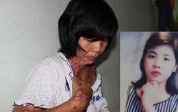 Lời kêu cứu xót xa của một nạn nhân bị tạt axit