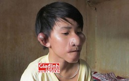 Cuộc sống cơ cực của cậu bé "Trư Bát Giới" bị cha nhẫn tâm bỏ rơi từ lúc lọt lòng