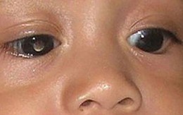 Cặp vợ chồng trẻ hiến mỗi người một mắt để con trai nhìn thấy ánh sáng
