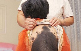 Bé gái được mệnh danh là "Miêu nữ" vì làn da mọc kín lông đen