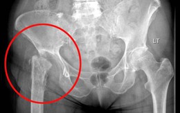 Một phụ nữ Anh bị bác sỹ làm chân bị xoay 90 độ