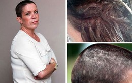 Gặp họa vì nối tóc bằng keo siêu dính