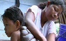 Cậu bé có vết bớt "khủng" như mai rùa