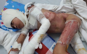 Người duy nhất còn sống trong nhà 3 người bỏng nặng đã phẫu thuật 10 lần