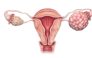 Dấu hiệu ung thư buồng trứng giai đoạn đầu