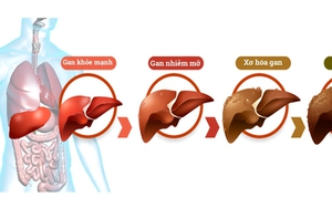 Người bị gan nhiễm mỡ không ăn 5 nhóm thực phẩm này để giảm gánh nặng cho gan!