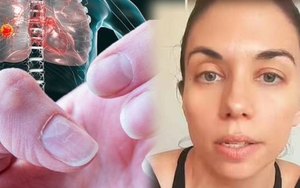 Người phụ nữ 35 tuổi mất 2 năm mới biết mình bị ung thư phổi vì các triệu chứng bị nhầm lẫn là do căng thẳng