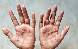 TP Hồ Chí Minh thông tin về hai trường hợp mắc bệnh đậu mùa khỉ