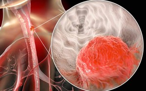 5 dấu hiệu ung thư thực quản dễ nhầm với bệnh khác, người Việt nên biết để tránh