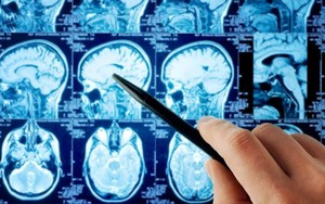 Trẻ 8 tuổi đã bị đột quỵ, dấu hiệu dễ nhầm lẫn với cảm cúm