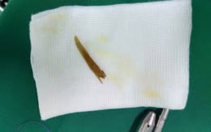 Nuốt phải xương gà, nhiều người bị thủng ruột non