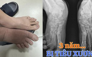 Chỉ sau cơn đau âm ỉ, người đàn ông tuyệt vọng vì bị "mất dần xương" và sự thật sau 3 năm đi tìm "thủ phạm"