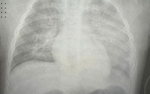 Bé gái 8 tuổi sốc nhiễm trùng, suy gan, phổi trắng xóa sau 6 giờ nhập viện vì biến chứng sởi