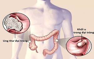 Dấu hiệu ung thư đại tràng bị nhiều người bỏ qua: Đầy hơi, đi ngoài phân nhỏ dẹt... đừng chủ quan