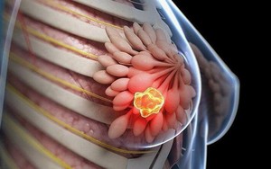 Không chỉ do di truyền: Ung thư vú đang gia tăng vì 5 thói quen này, bạn đã biết chưa?