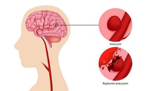 Xuất huyết não: Hiểm họa thầm lặng và cách phòng ngừa để bảo vệ não bộ