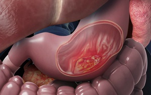 Người đàn ông phát hiện tiền ung thư dạ dày từ dấu từ một việc nhiều người Việt bỏ qua