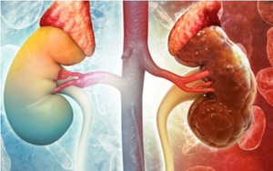 Thanh niên 25 tuổi suy thận giai đoạn cuối, phải ghép thận thừa nhận 1 sai lầm nhiều bạn trẻ Việt mắc phải