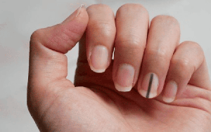 Móng tay nổi sọc dọc báo động nguy hiểm? Đừng chủ quan nếu thấy 4 đặc điểm này
