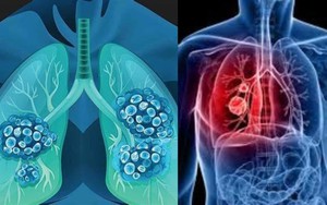 Người đàn ông 68 tuổi phát hiện ung thư phổi di căn từ những dấu hiệu người Việt dễ bỏ qua