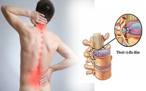 Bé 11 tuổi phát hiện mắc thoát vị đĩa đệm từ dấu hiệu nhiều người Việt mắc phải