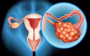 Người phụ nữ 41 tuổi đi khám phát hiện ung thư buồng trứng từ dấu hiệu nhiều chị em Việt mắc phải