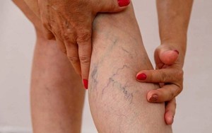 5 điều bác sĩ mạch máu nhắn nhủ bệnh nhân suy giãn tĩnh mạch ăn Tết vui khỏe, hạn chế gặp nhau trong bệnh viện