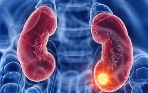 Người đàn ông suy thận giai đoạn 3 ân hận vì tự ý làm điều này khiến bệnh trầm trọng hơn