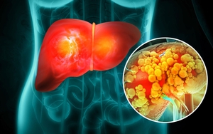 Một thói quen ăn uống quen thuộc có thể làm tăng nguy cơ ung thư gan, người Việt nên tránh