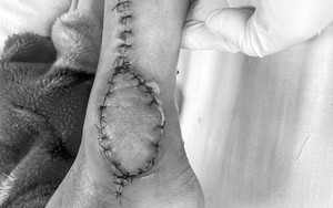 Bé 8 tuổi ở Hà Nội phát hiện mắc ung thư sụn từ dấu hiệu đau chân bất thường