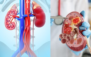 7 loại trái cây quen thuộc người bệnh suy thận nên hạn chế, nhiều người Việt vẫn ăn mỗi ngày