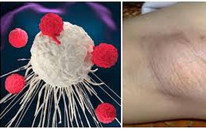 Doanh nhân 59 tuổi người Anh phát hiện ung thư hạch, thừa nhận bỏ qua dấu hiệu nổi hạch ở nách