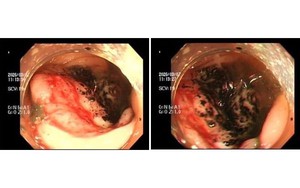 Nhiều 9X phát hiện ung thư đại trực tràng ở giai đoạn nặng từ nhiều dấu hiệu cho rằng do 'áp lực công việc'