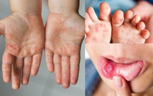 Bệnh tay chân miệng tăng nhanh, xuất hiện chủng nguy hiểm: Cha mẹ cần làm gì để bảo vệ trẻ?