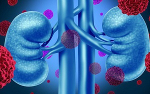 Người phụ nữ 67 tuổi bất ngờ phát hiện ung thư thận giai đoạn sớm từ 1 việc nhiều người Việt bỏ qua