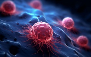 Người đàn ông 51 tuổi mắc cùng lúc 2 loại ung thư nguy hiểm từ dấu hiệu nhiều người Việt bỏ qua