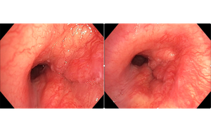 Người đàn ông 32 tuổi phát hiện ung thư phổi hiếm gặp từ dấu hiệu nhiều người Việt mắc phải