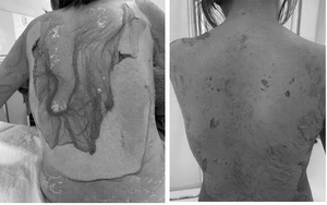 Người phụ nữ 35 tuổi bị tróc da toàn thân thừa nhận 1 sai lầm nhiều người Việt mắc phải