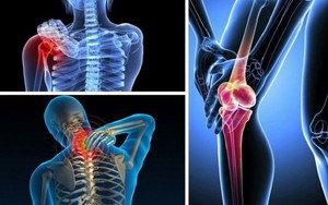 Bác sĩ cảnh báo 6 dấu hiệu ung thư xương giai đoạn đầu mà nhiều người vẫn nghĩ là thiếu canxi