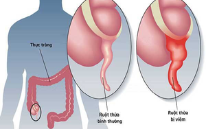 Chủ quan với đau bụng âm ỉ, người đàn ông suýt vỡ ruột thừa vì nghĩ chỉ rối loạn tiêu hóa