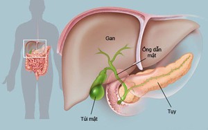Người phụ nữ 36 tuổi bất ngờ phát hiện đa polyp túi mật khi đi khám giảm cân