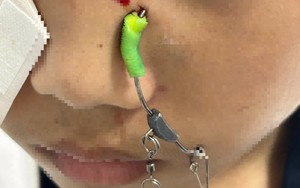 Đi học về, bé trai 11 tuổi ở Hà Nội bị lưỡi câu găm sâu vào mặt